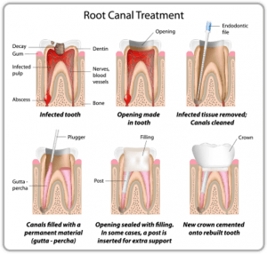 Root Canal Treatment Chart Root Canal Treatment Chart