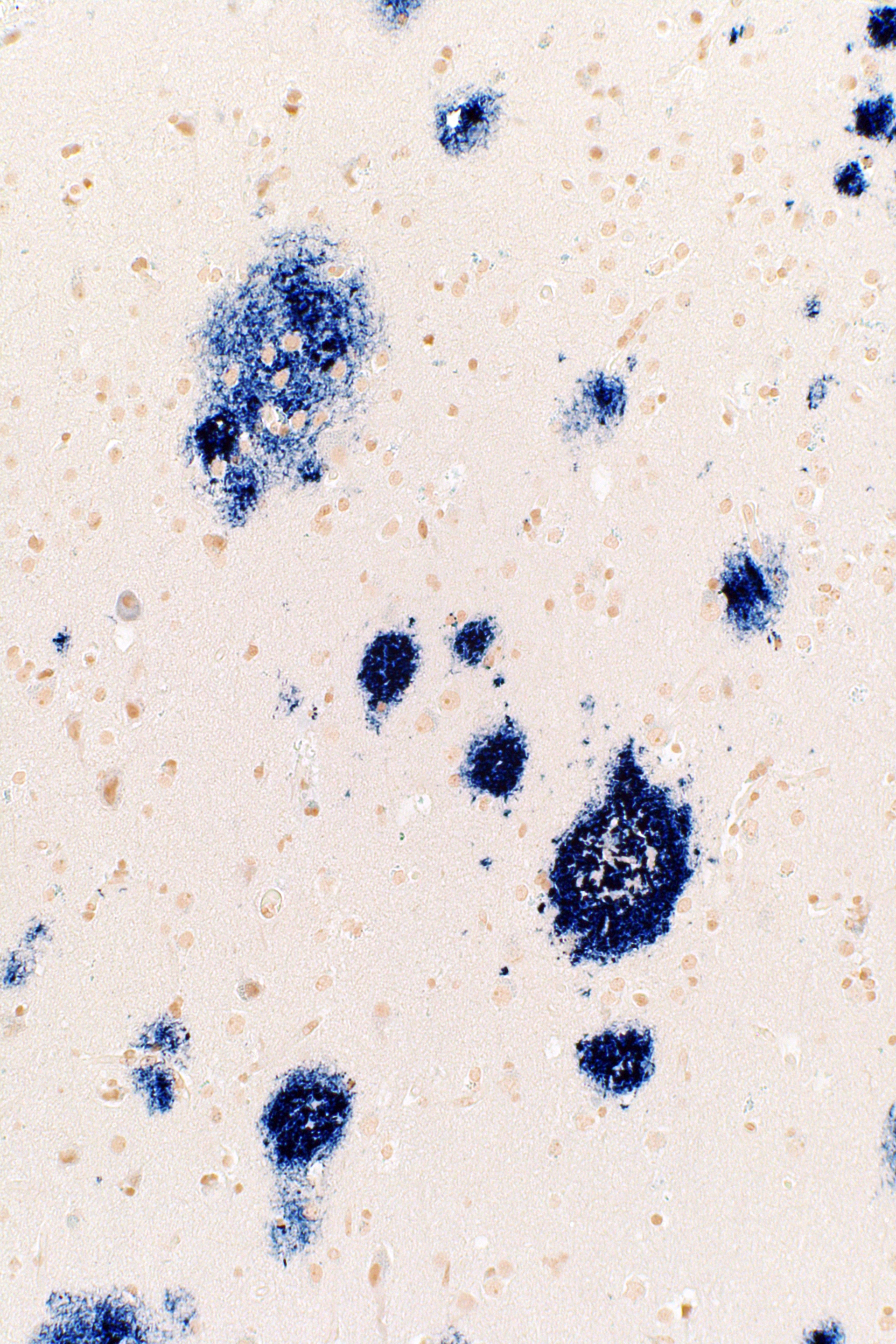 Amyloid beta immunostaining showing amyloid plaques (brown).