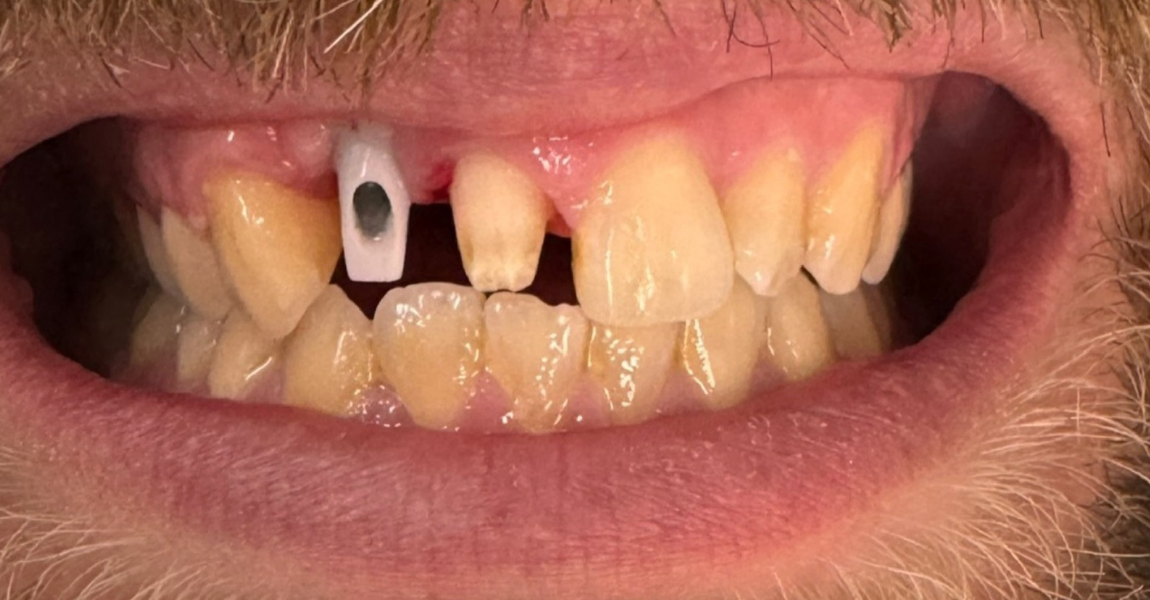 A close up of a man 's mouth with a beard and missing teeth.