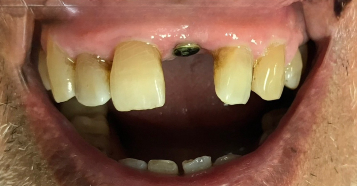 A close up of a person 's mouth with white teeth.