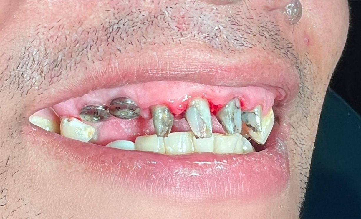 A close up of a person 's teeth with a tooth color chart.