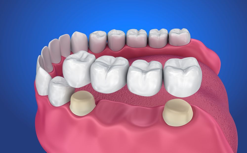 A computer generated image of a dental bridge in a person 's mouth.