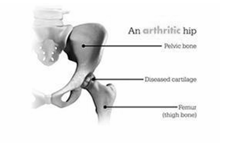 A diagram of an arthritis hip showing the pelvic bone , femur , and thigh bone.