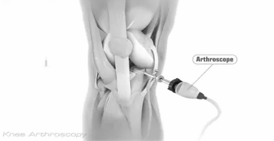 Kidney stone, urinary stone, ureteric stone, renal calculi, renal colic, nephrolithiasis