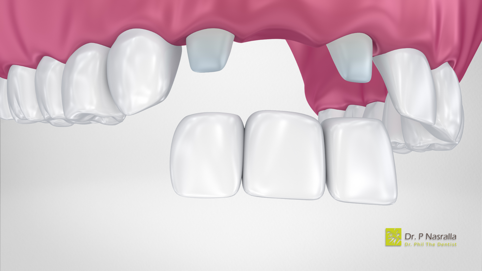 Dr. Phil The Dentist’s Approach to Tooth Replacement