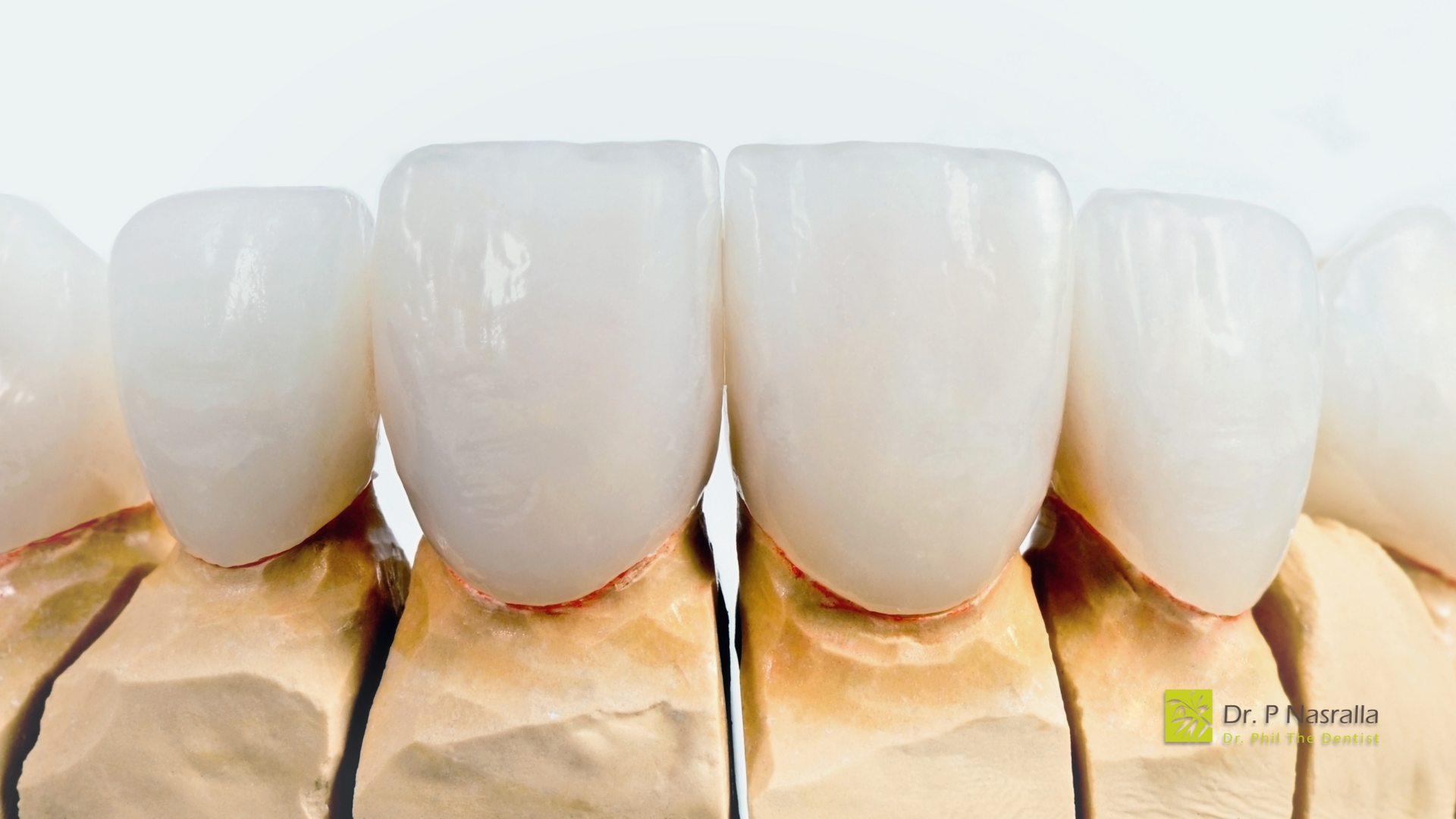 Close-up of porcelain veneers on dental models, showing bright white, even teeth.