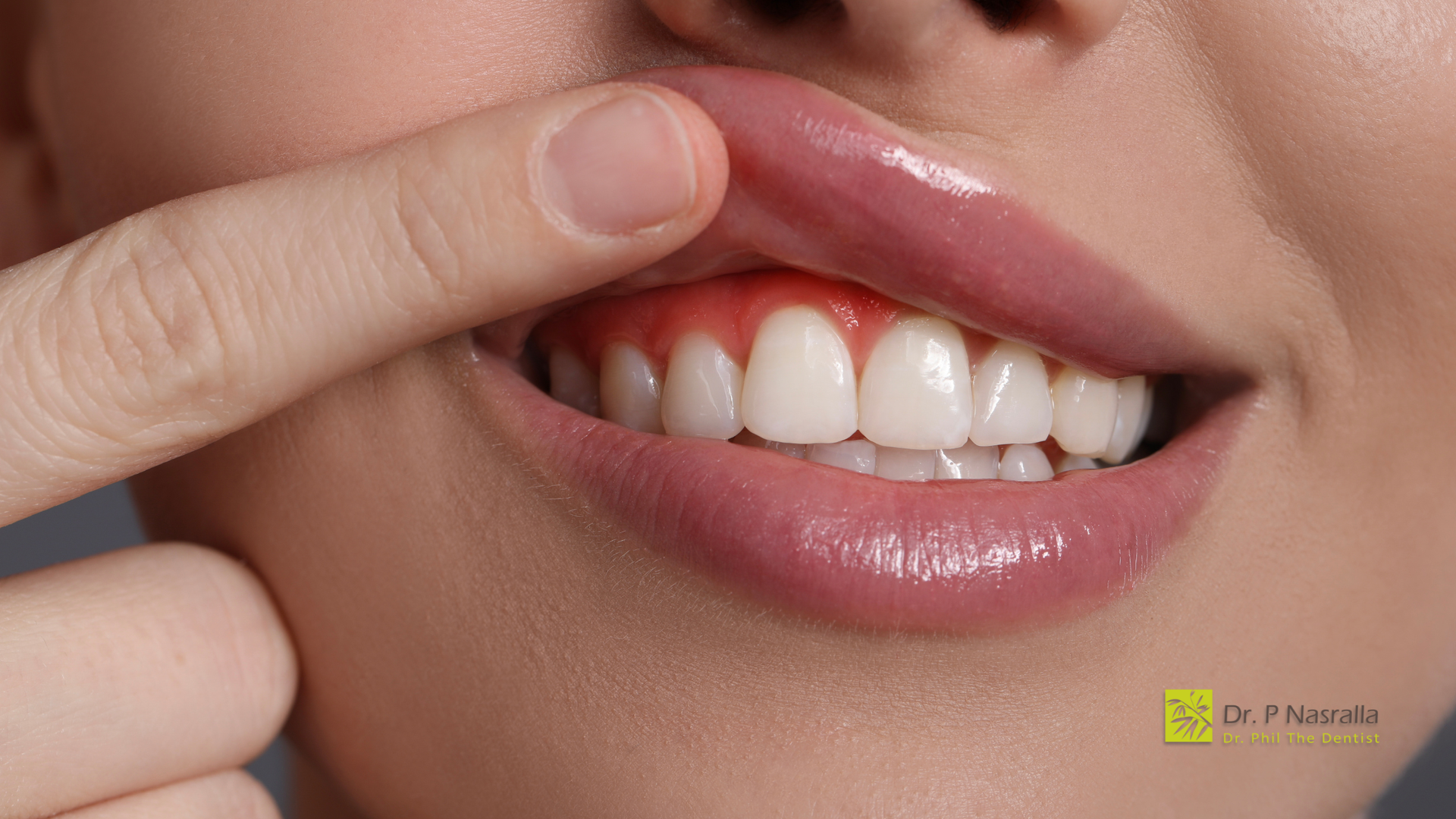 Person pointing at gums with redness along teeth. White teeth.