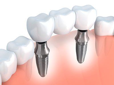 implant supported bridge | dentist near you | Dr. Phil The Dentist | Dentist In Comox, BC