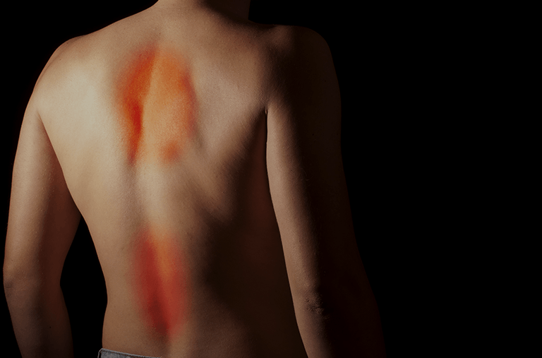A man 's back is shown with red spots on it.