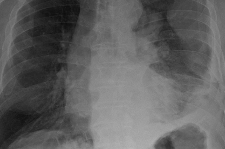 A black and white x-ray of a person 's chest shows a large amount of fluid in the lungs.