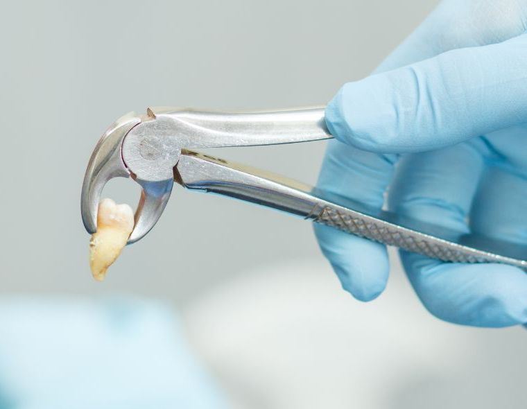 Gloved hand holding a dental extraction tool removing a tooth from a model jaw
