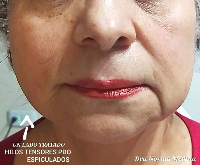 Hilos Tensores