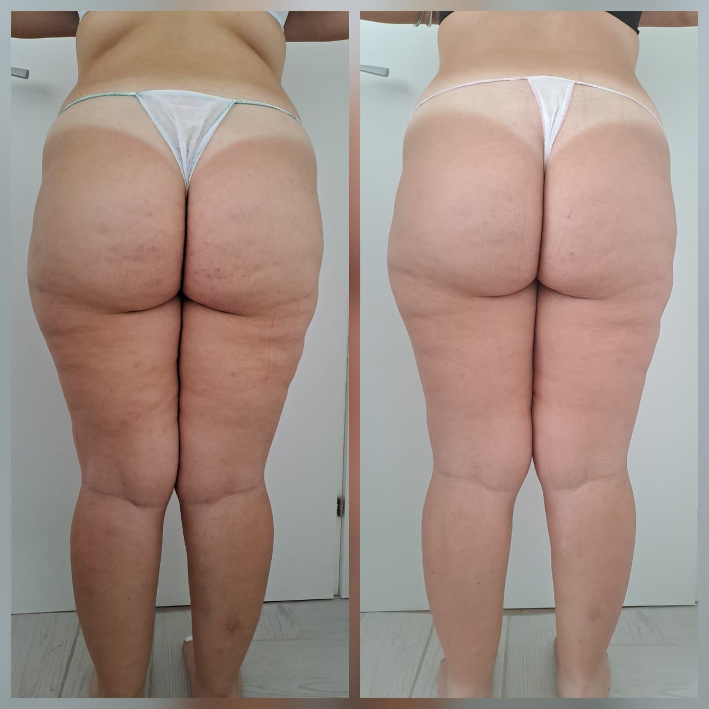 Prima e dopo, che mostrano una riduzione della cellulite e una pelle più liscia sulle cosce.