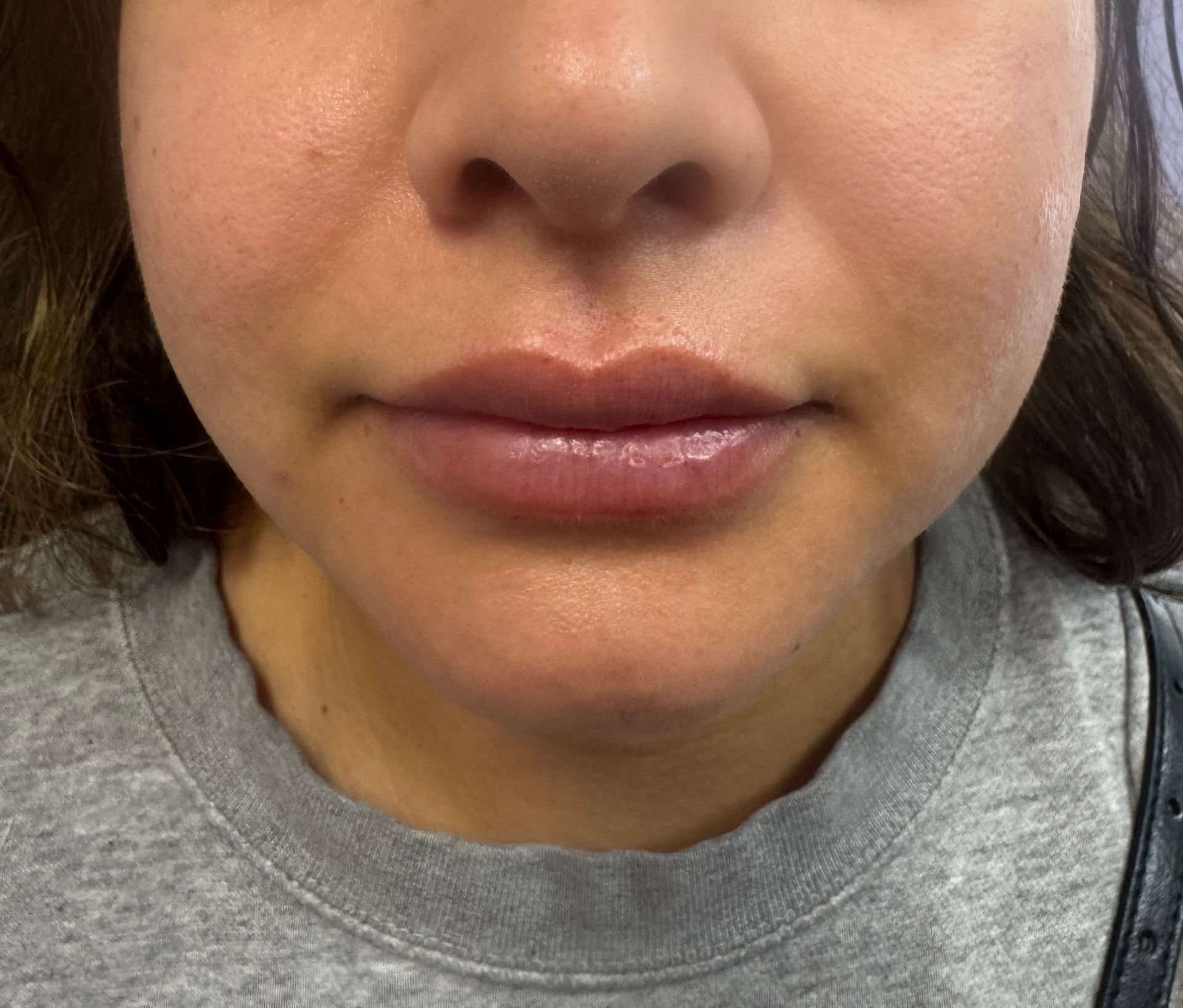After Lip Injections