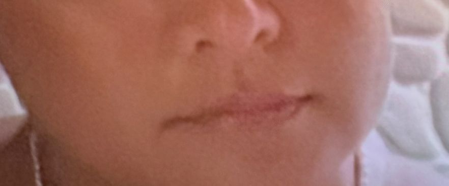 Before Lip Injections