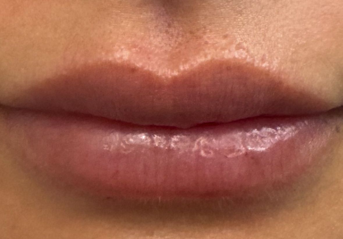 Lips during Lip Injections treatment