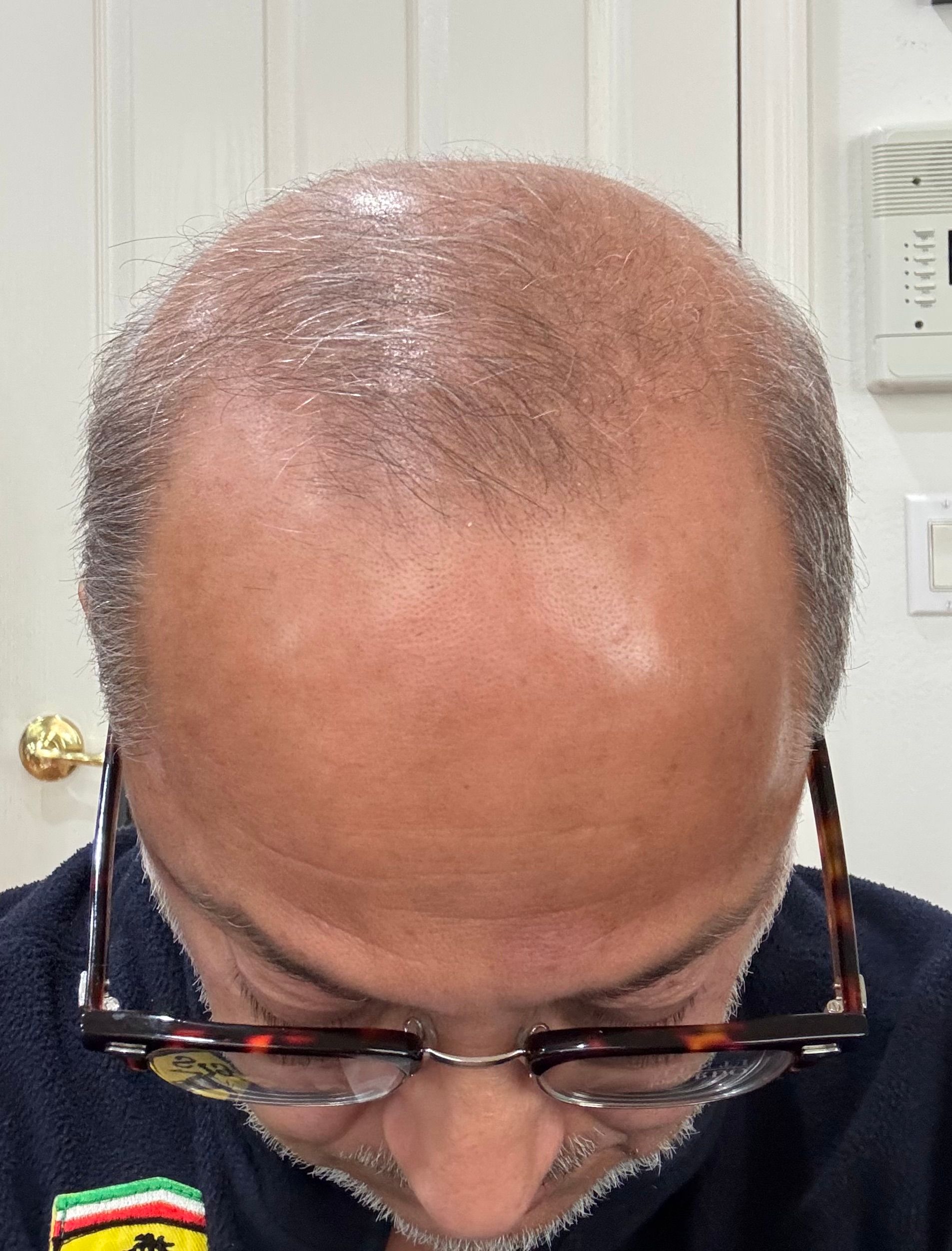 Hair Loss Treatment