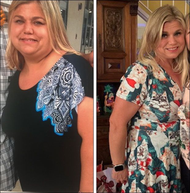 Before & After weight loss
