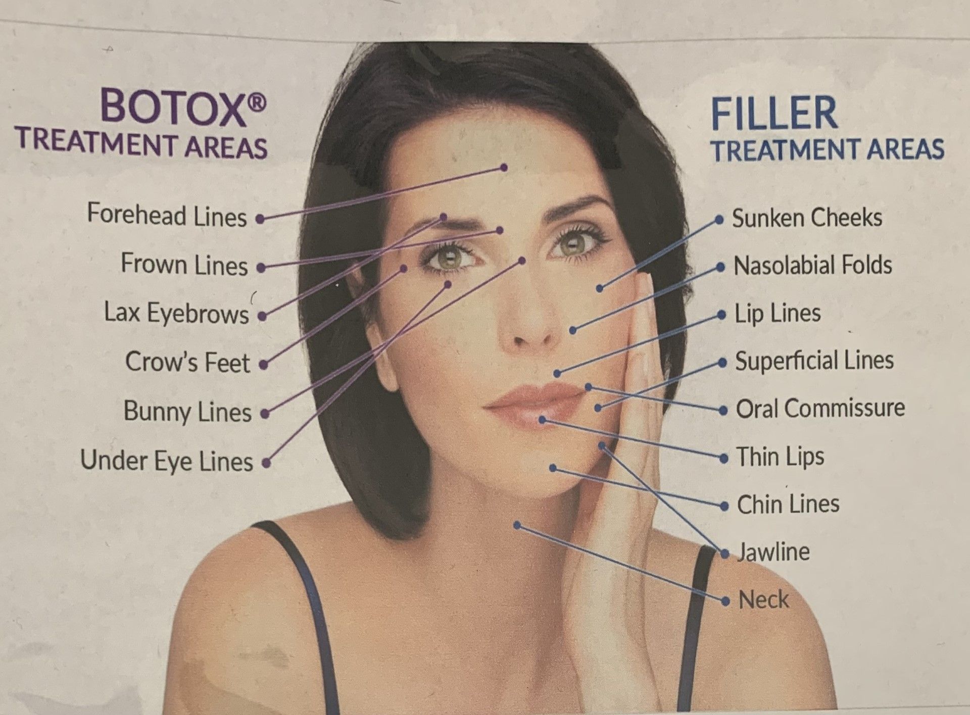 A diagram detailing Botox and filler treatment areas
