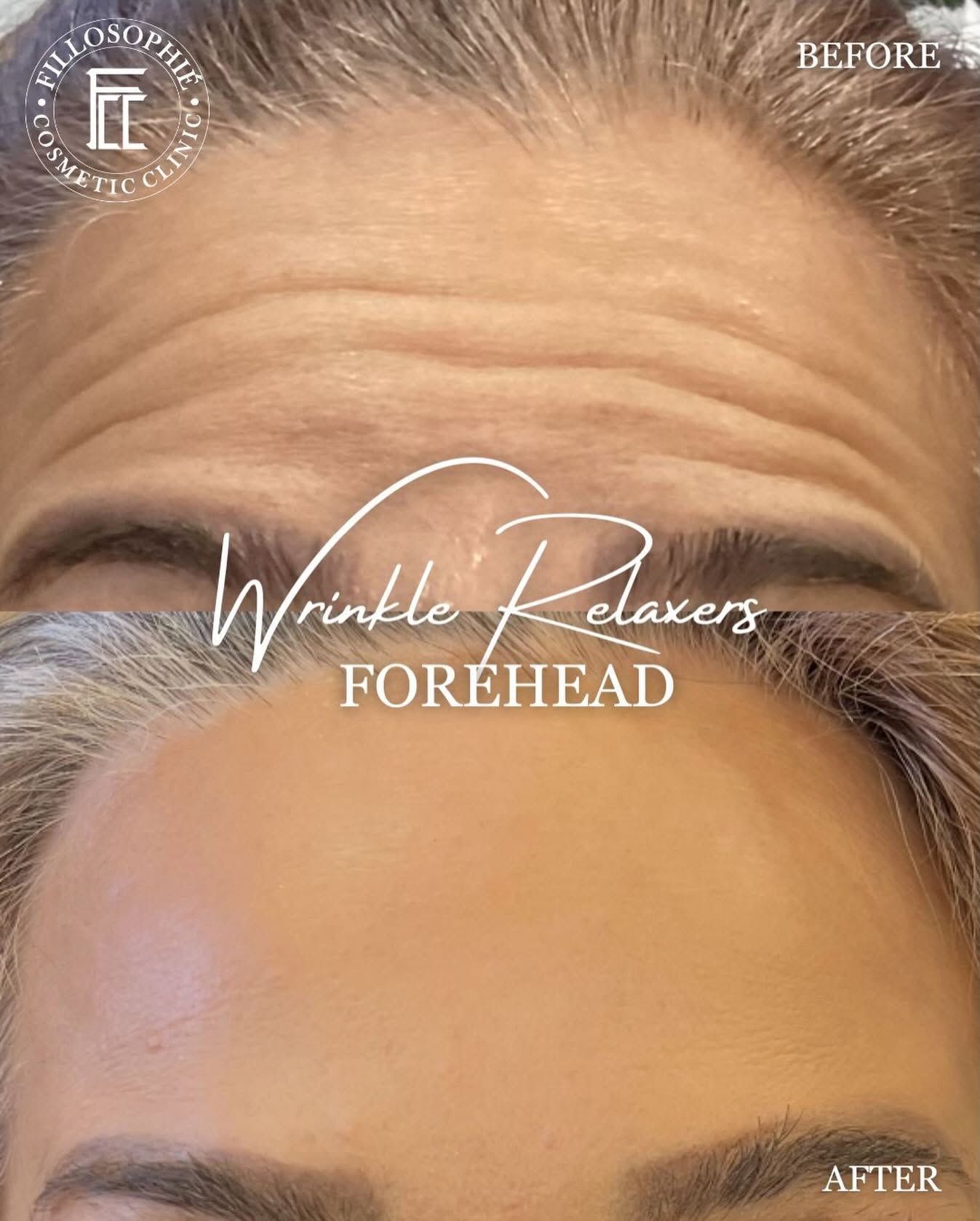 Forehead before-and-after showing reduced wrinkles on a woman’s forehead