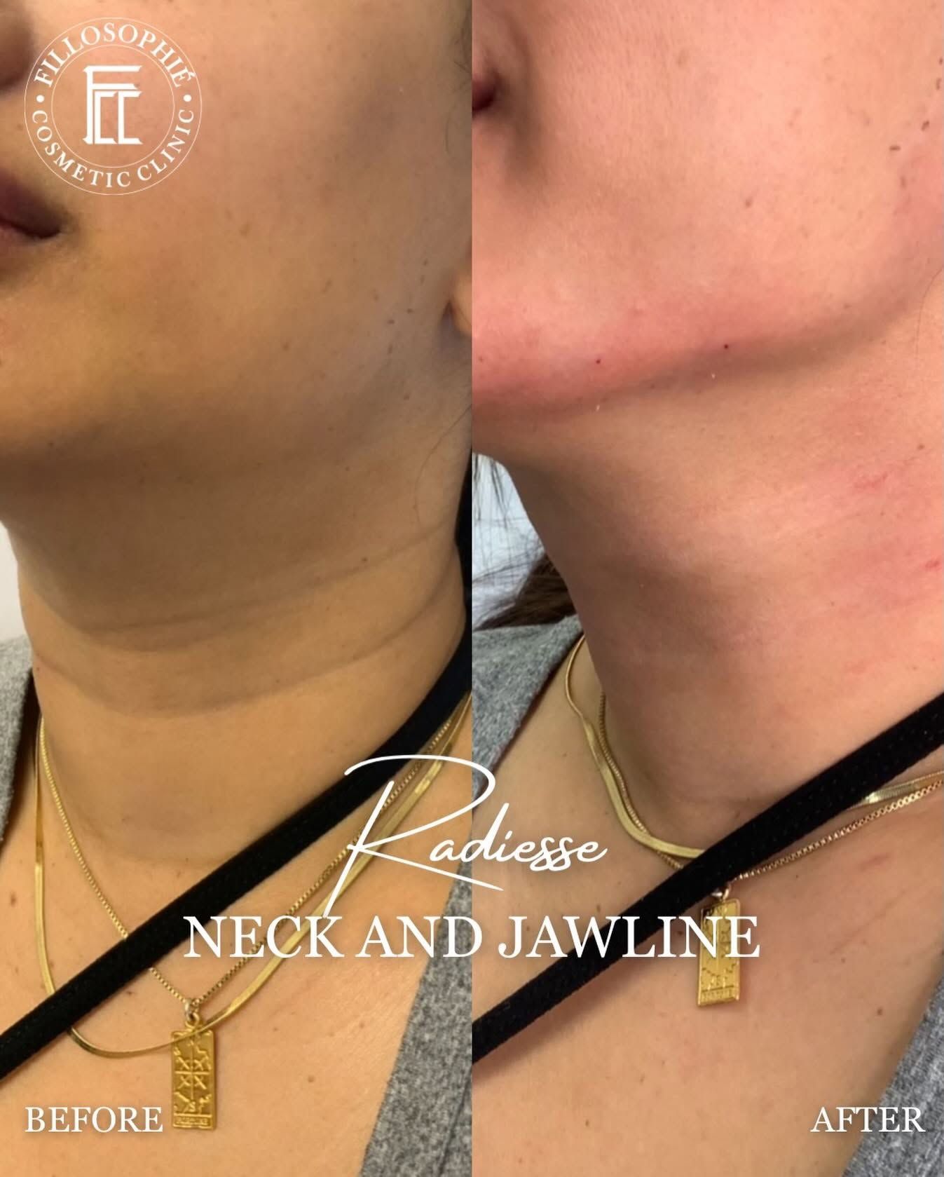 Before-and-after close-up of a neck and jawline treatment, showing smoother skin and reduced chin fullness.