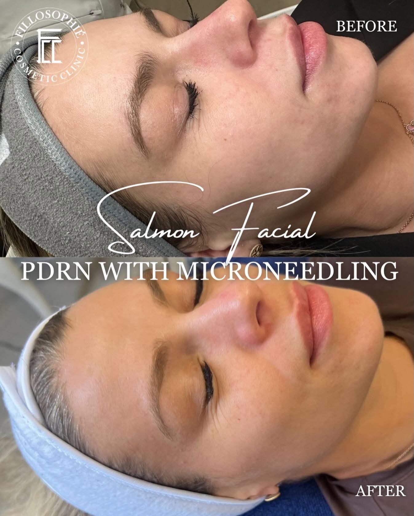 Before-and-after facial close-up with text: “Salmon facial PDRN with microneedling.”