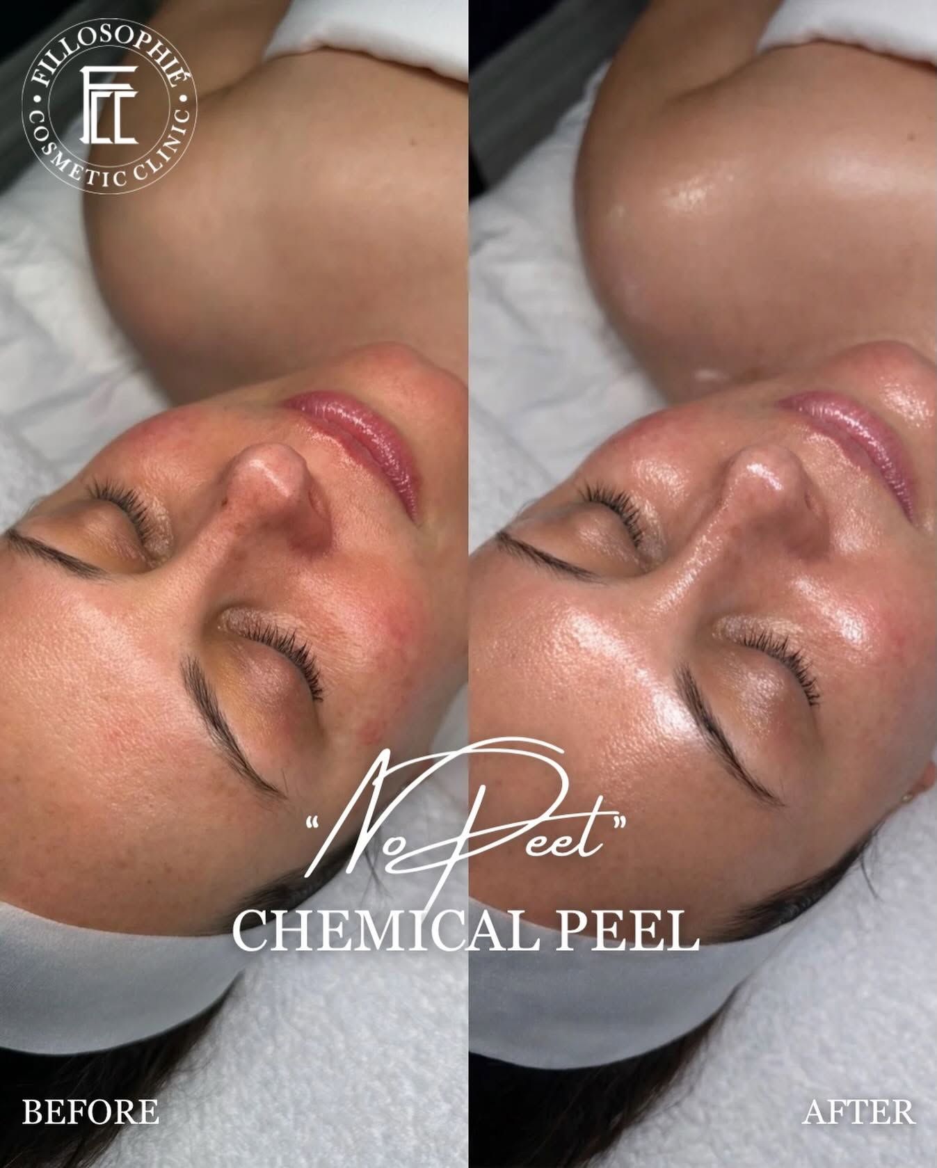 Before-and-after of a woman’s face after a chemical peel treatment, skin looks brighter and smoother.