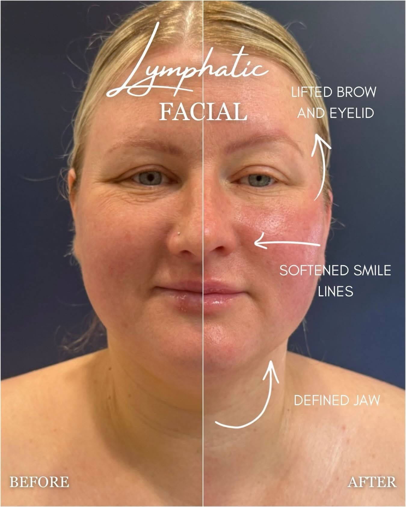 Before-and-after face graphic showing lifted brow and eyelid, softened smile lines, and a defined jaw.