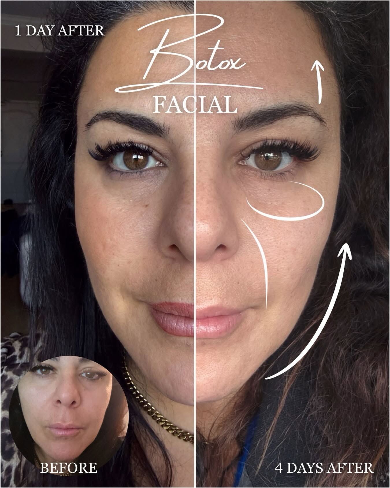 Split-face before-and-after facial results with white arrows and labels showing one-day vs four-day improvement.