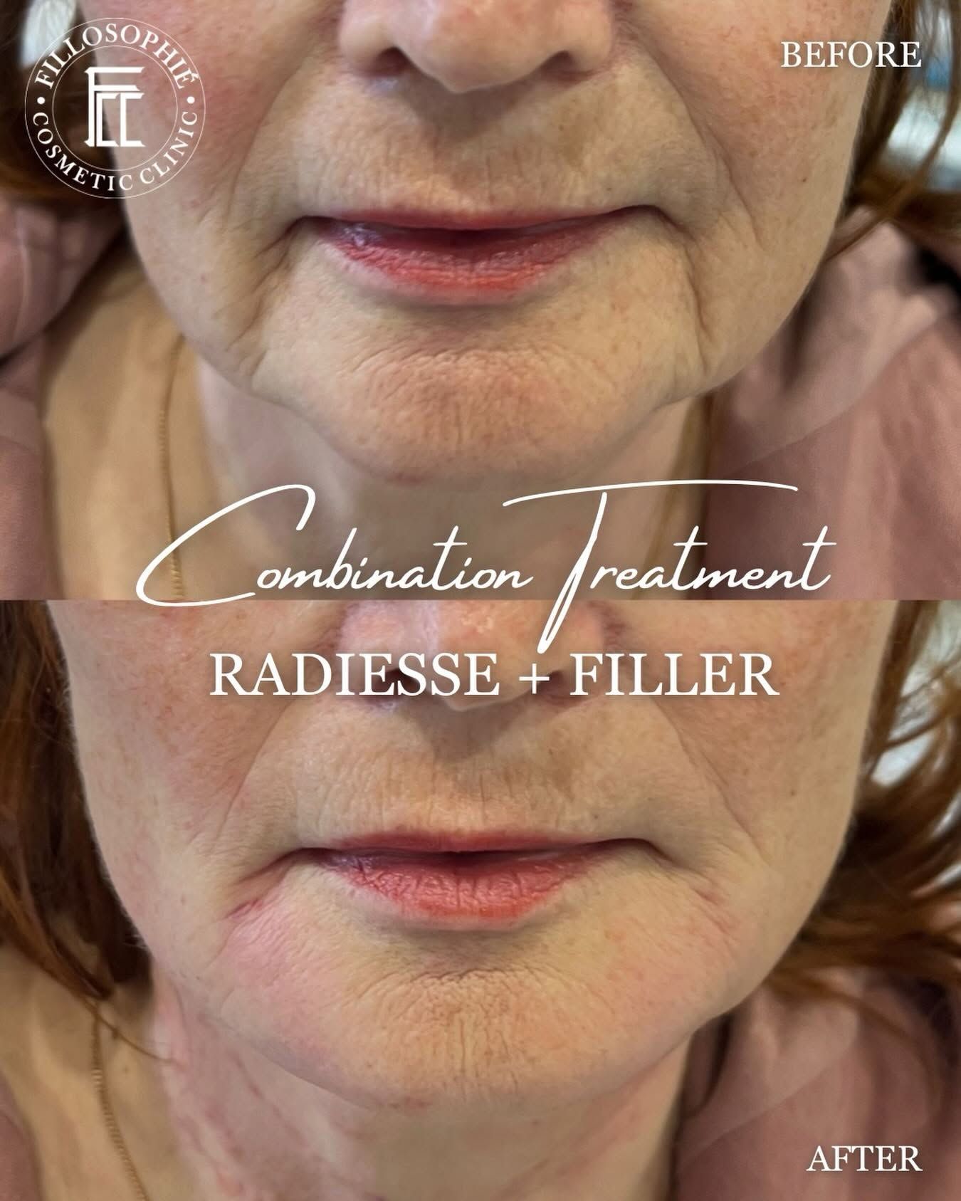 Before-and-after close-up of lower face showing a combination treatment: Radiesse + filler.