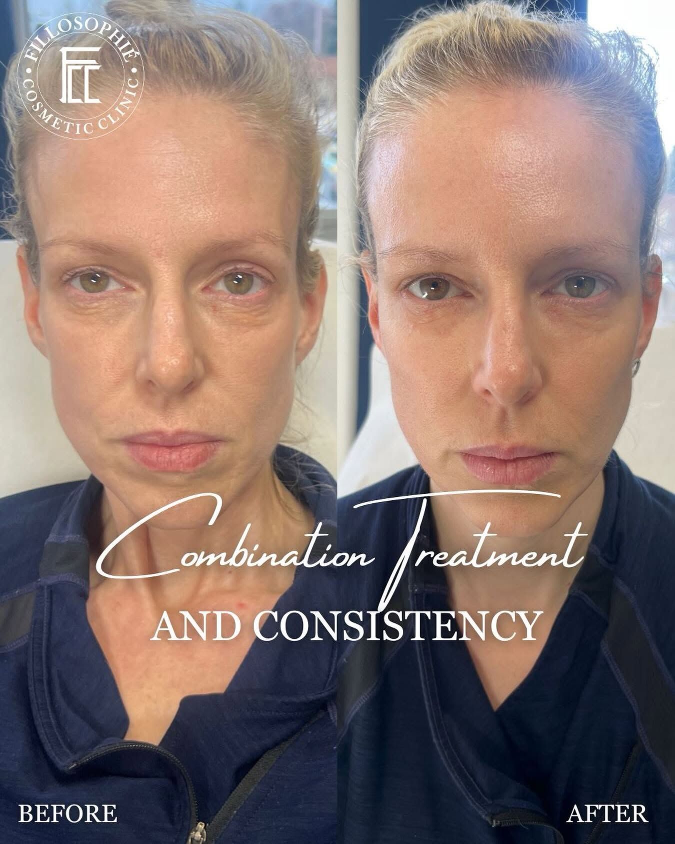 Before-and-after split portrait showing facial skin improvement after combination treatment and consistency.