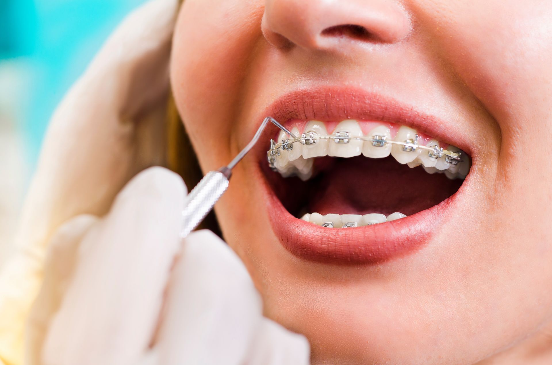 A woman with braces is getting her teeth examined by a dentist.
