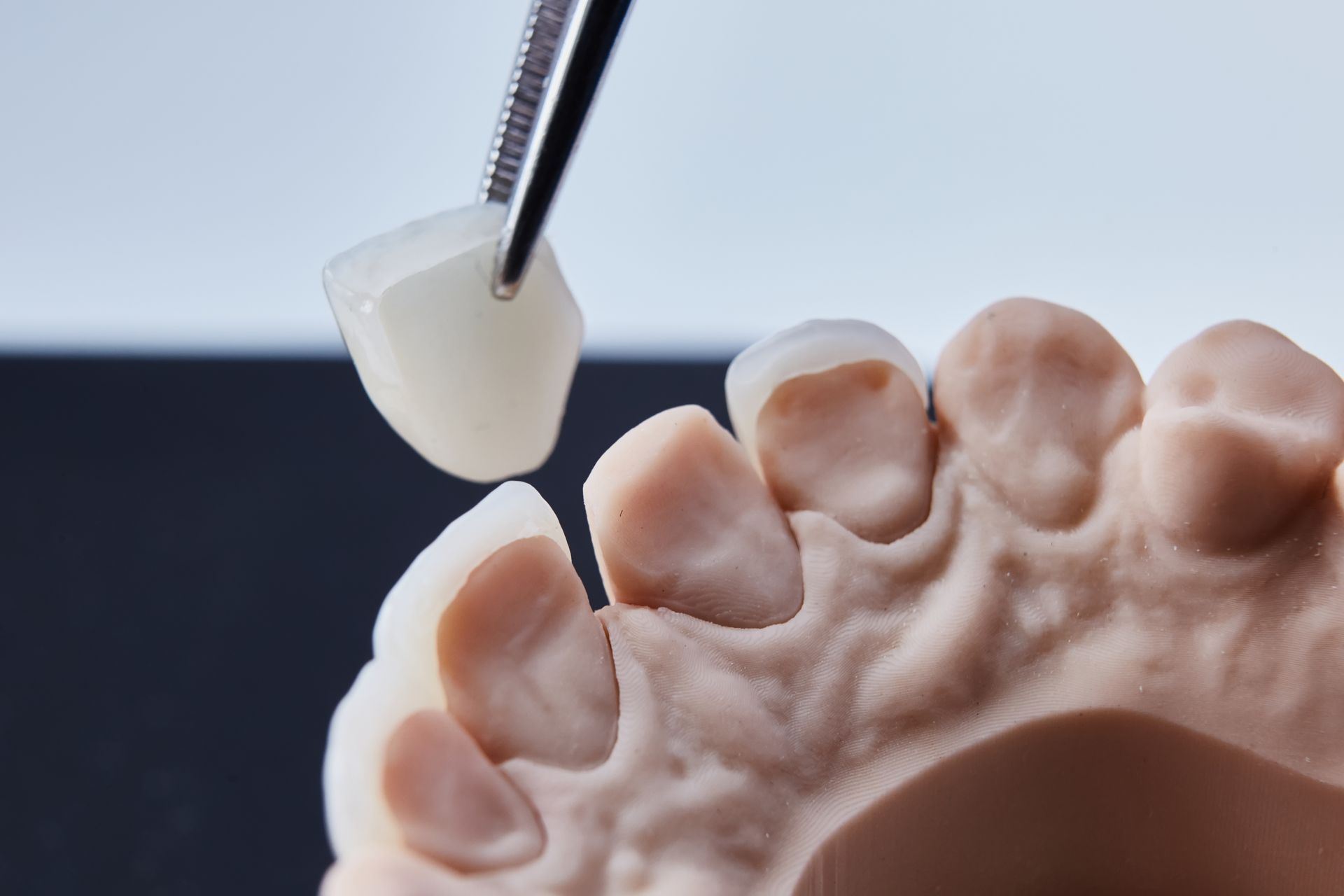 Dental model with a porcelain veneer being held by tweezers, ready for placement.