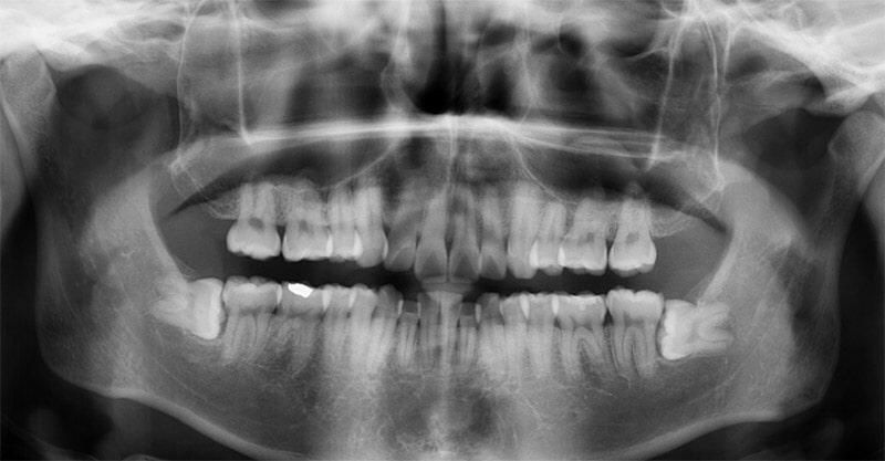 Razones por las que debes visitar al dentista cada 6 meses