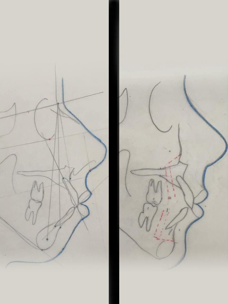 mentoplastia