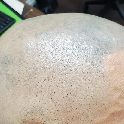 Close-up of a bald scalp with small dark spots and a few faint marks, resting near a keyboard