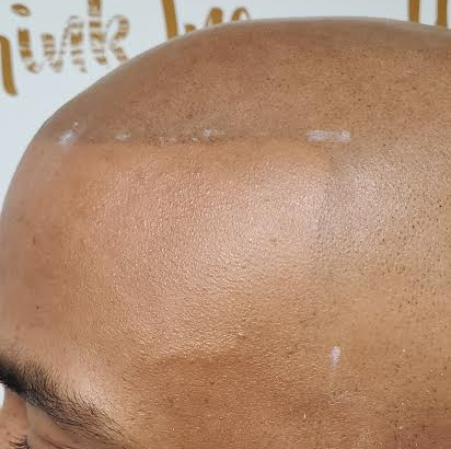 Close-up of a bald scalp with a few small light spots and a white background