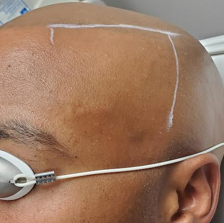 A close up of a man 's head with a white line drawn on it
