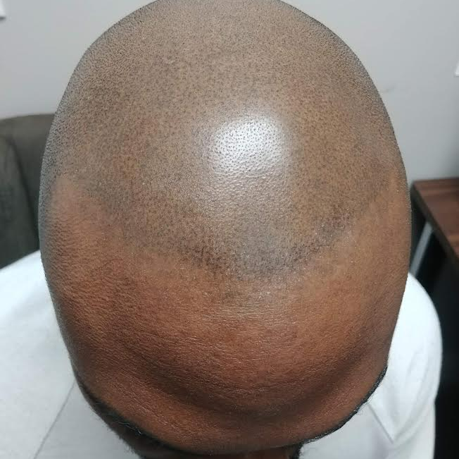 Close-up of a shaved head with a shiny scalp and visible light reflection from above