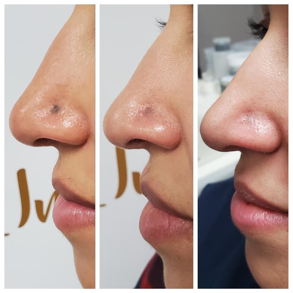 before & after phases of argyria treatment