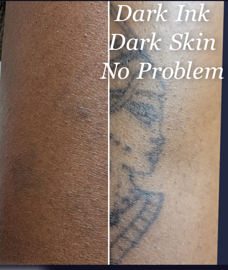 Side-by-side close-up of tattooed skin; text reads “Dark Ink Dark Skin No Problem.”
