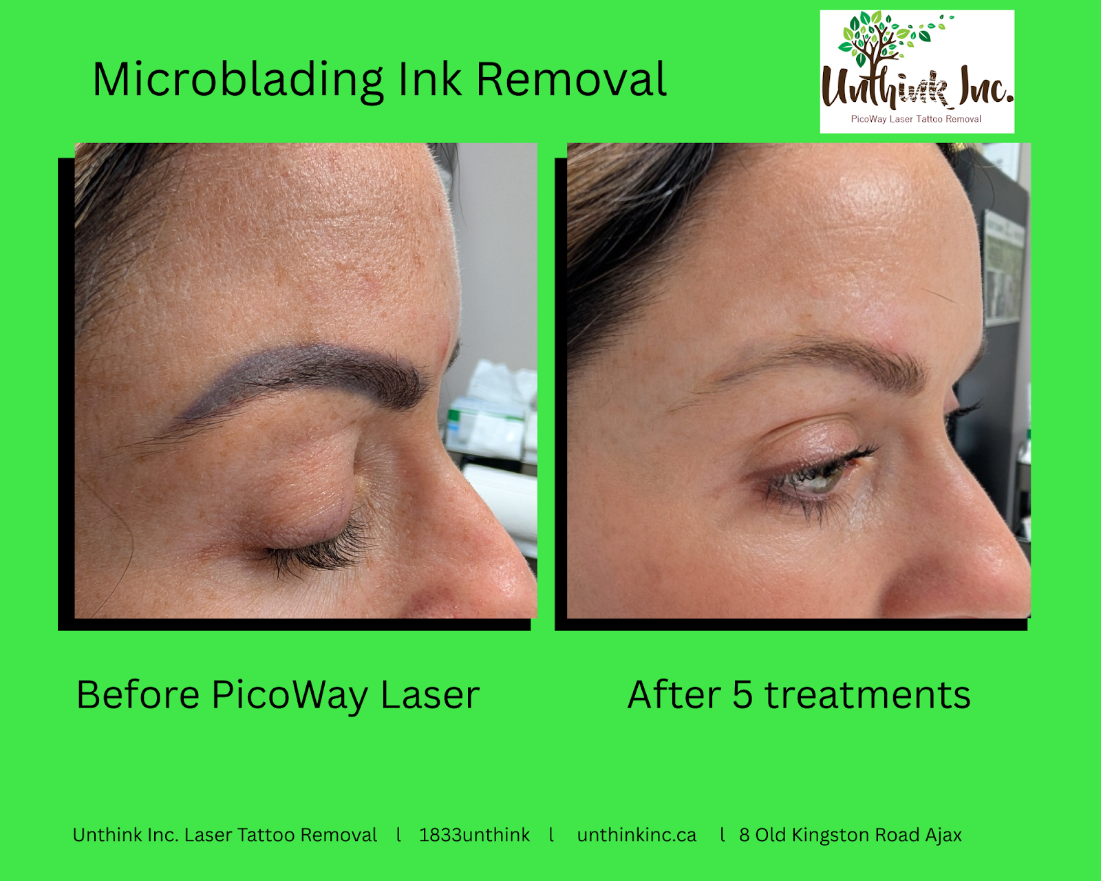 Microblading ink removal before and after with PicoWay laser, showing eyebrow lightening after 5 treatments