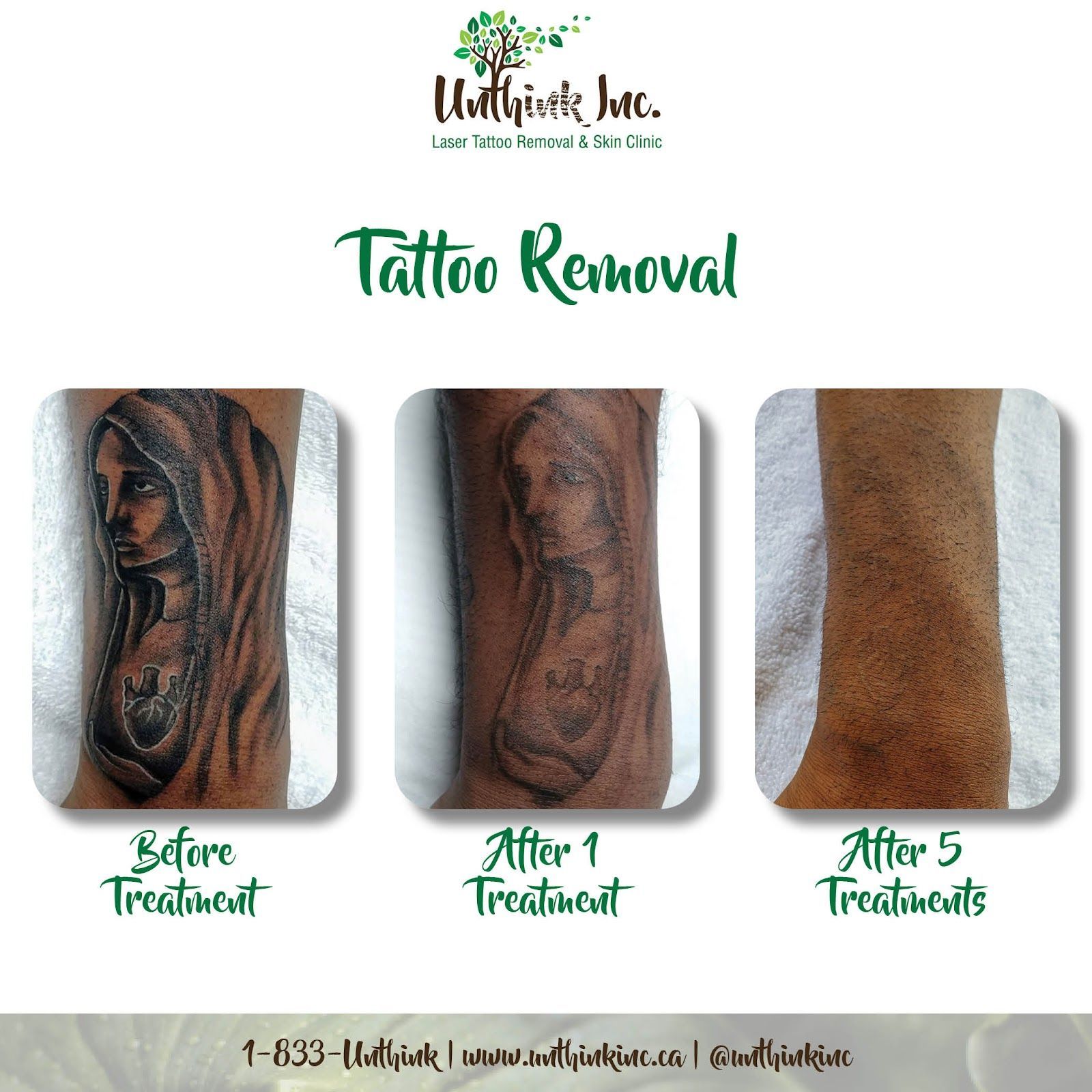 Tattoo removal before-and-after comparison showing progress over 1 and 5 treatments