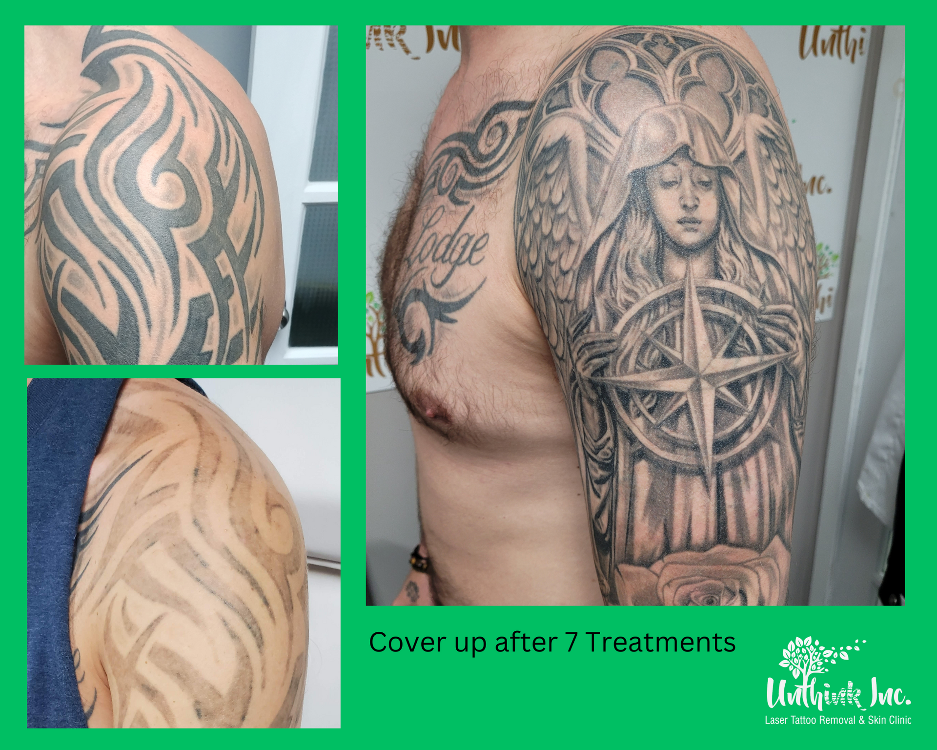 Tattoo cover-up comparison: old tribal design removed, new detailed black-and-gray chest tattoo after 7 sessions