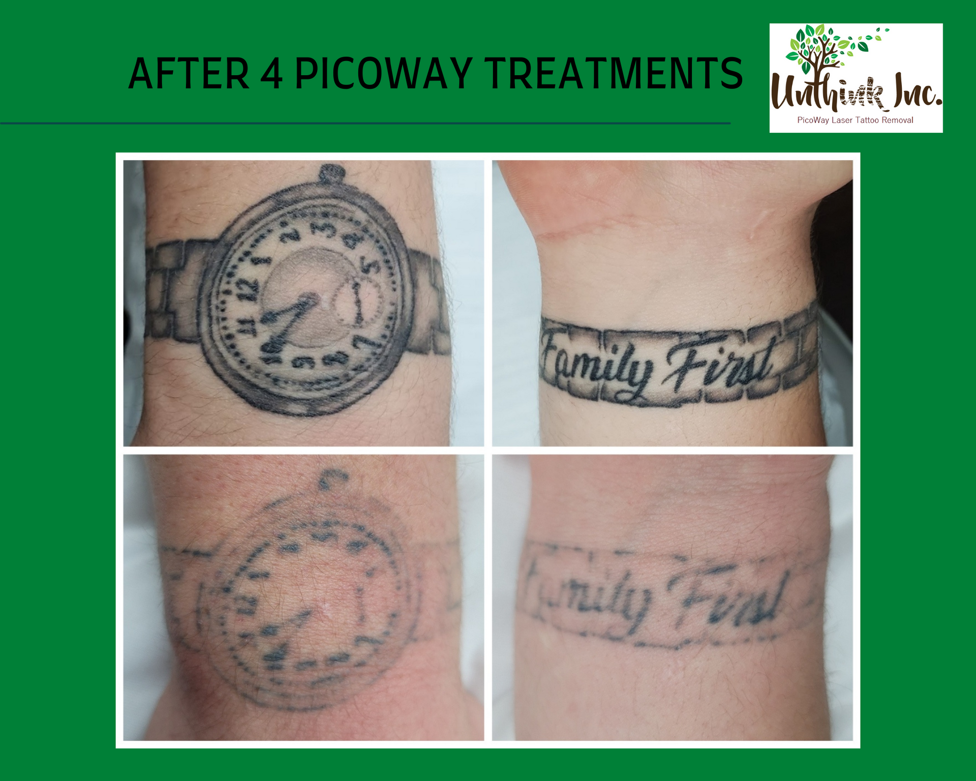 Before-and-after tattoo fading: two wrist tattoos after 4 Picoway treatments.