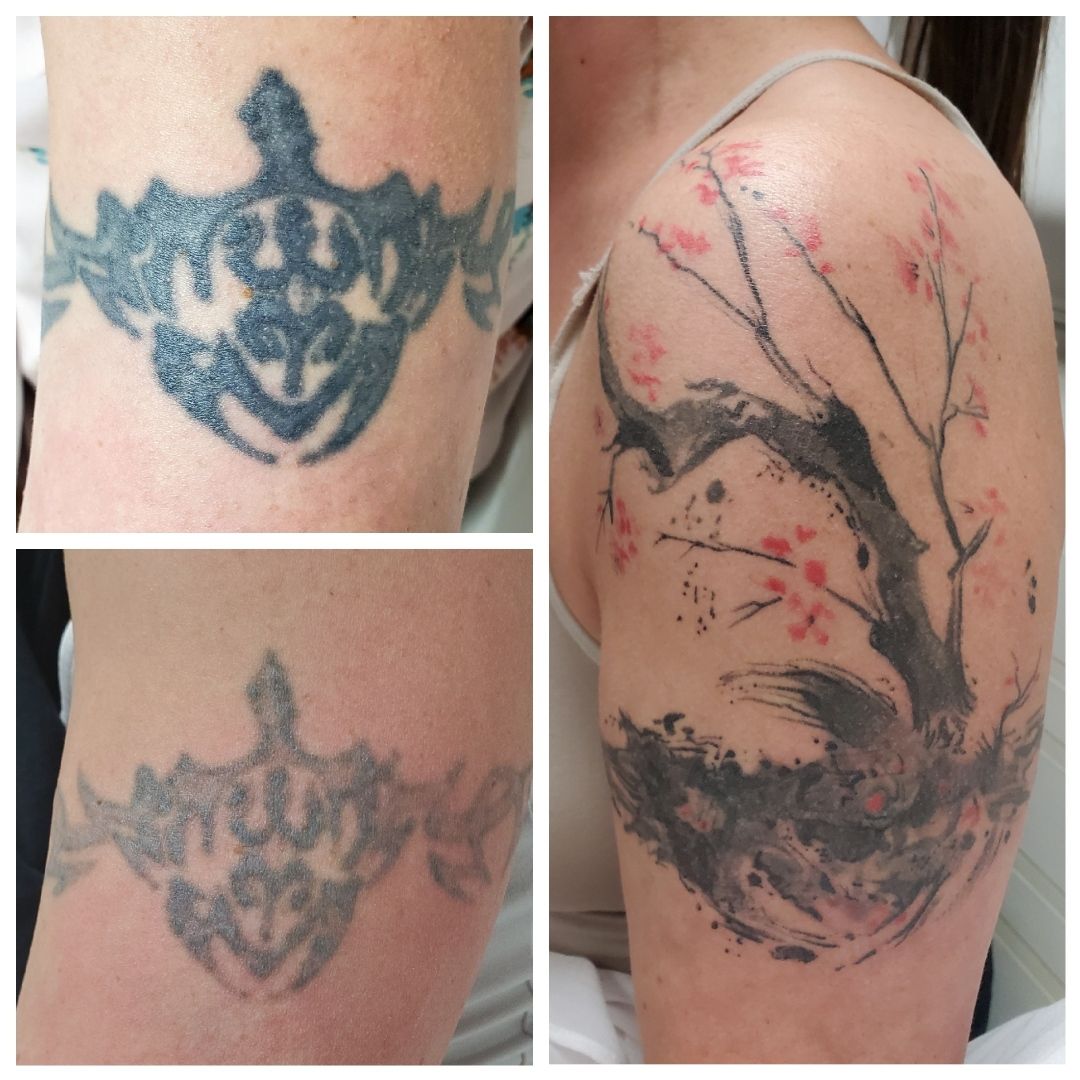 Before-and-after close-up of a tattoo removal on skin, showing faded blue-black ink and a larger fading tattoo design.