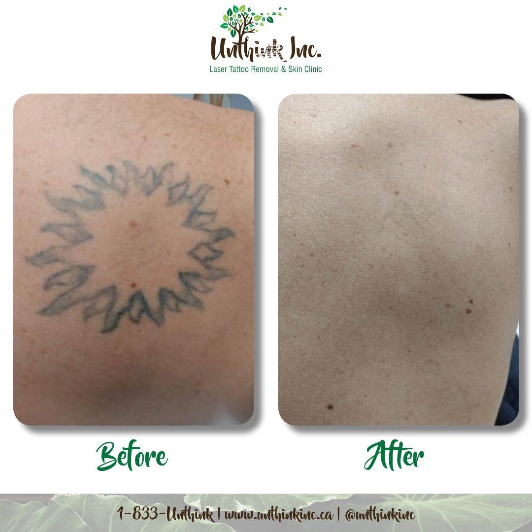 Before-and-after skin photos showing a faded circular tattoo removal result.