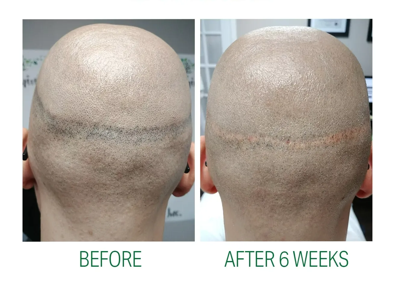 Side-by-side scalp photos labeled “Before” and “After 6 weeks,” showing hair regrowth on a bald head.