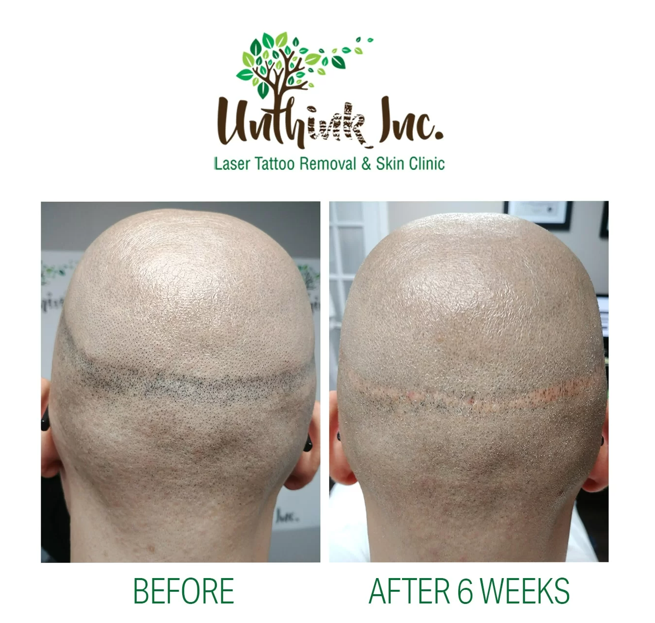 Before-and-after scalp close-up showing tattooed hairline improvement over 6 weeks.