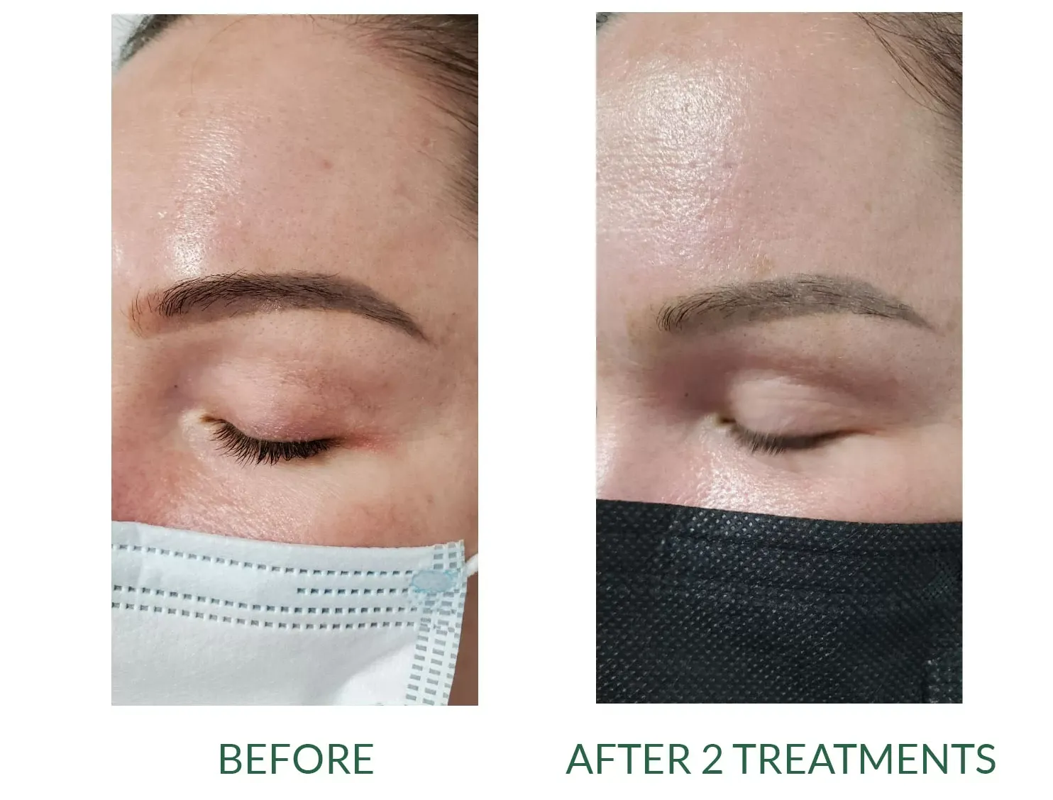 Side-by-side eyebrow close-up: before and after 2 treatments, showing fuller, darker brows.